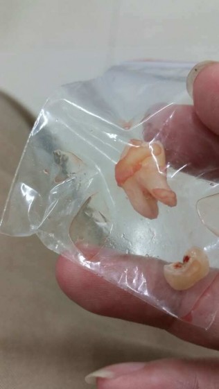 切开，拔掉！智齿，想死！