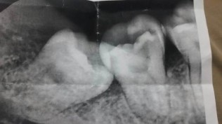 果断决定切割智齿拔掉！